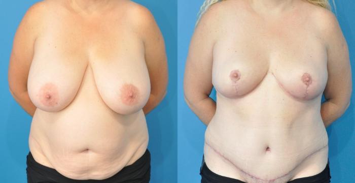 Before & After Breast Reduction Case 227 View #1 View in North Shore, IL