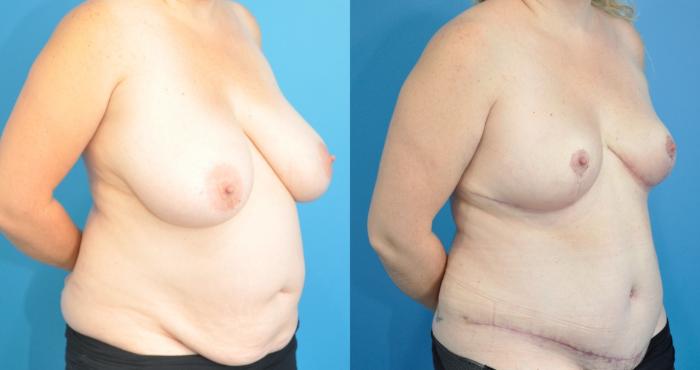 Before & After Breast Reduction Case 227 View #2 View in North Shore, IL