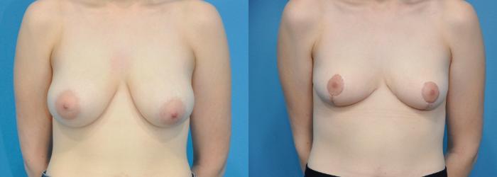 Before & After Breast Reduction Case 228 View #1 View in North Shore, IL
