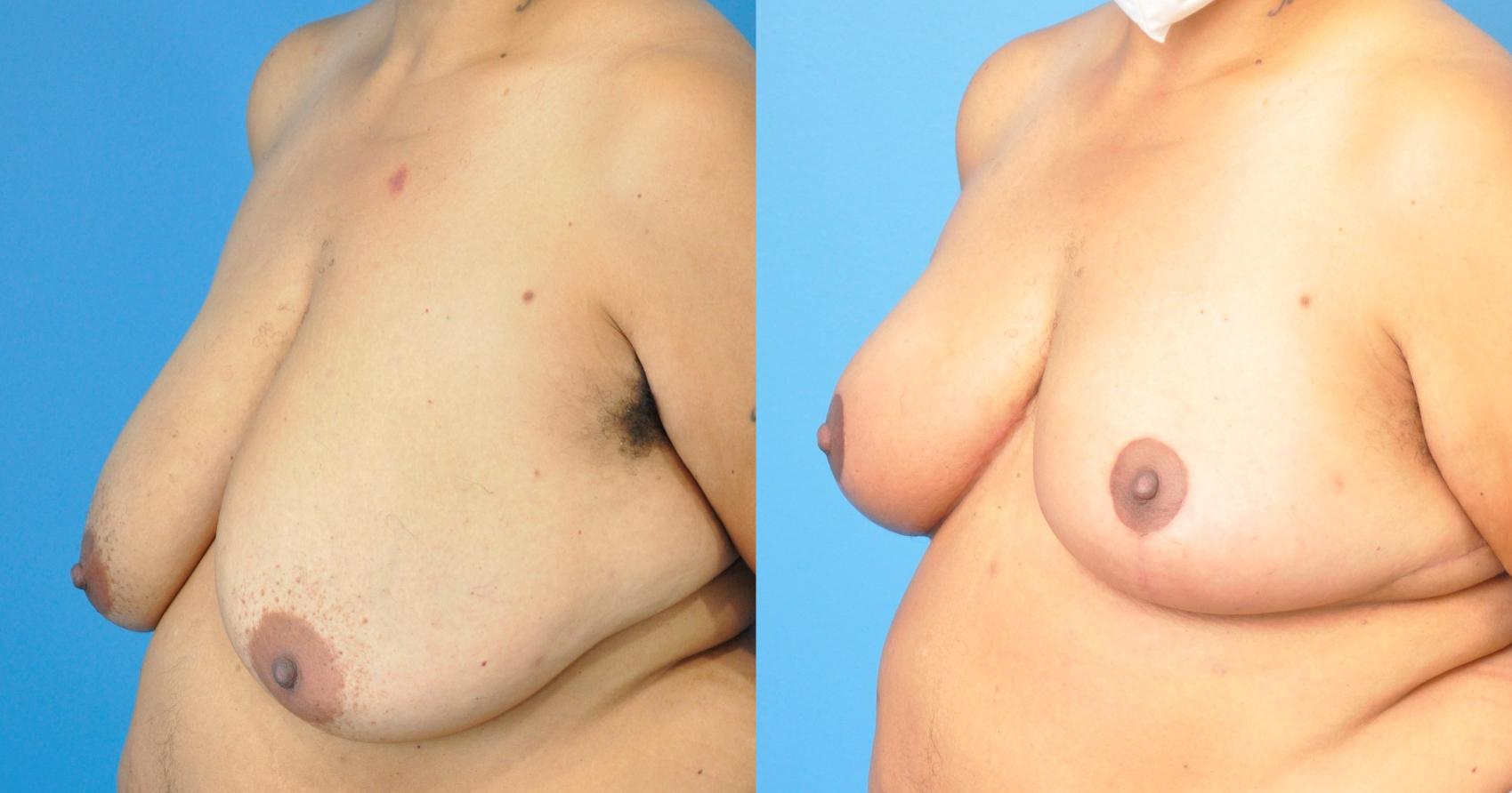 Before & After Breast Reduction Case 239 View #2 View in Northbrook, IL