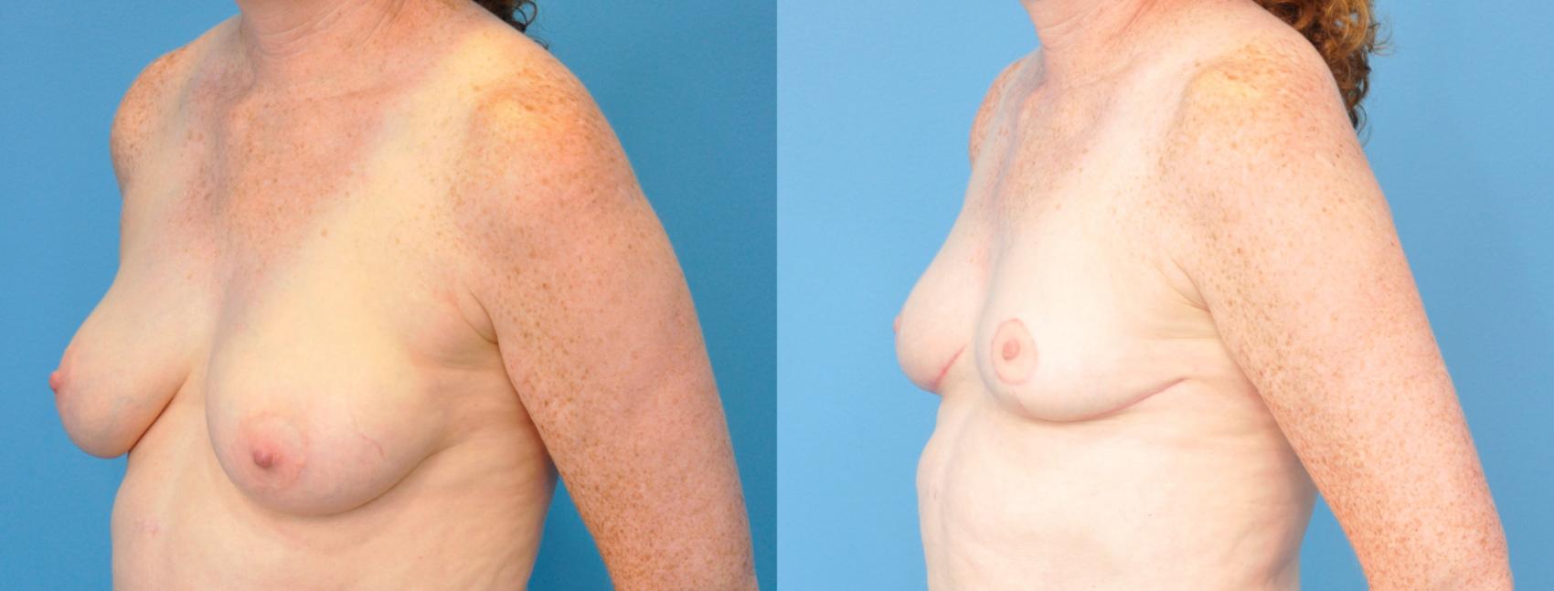 Before & After Breast Reduction Case 243 View #2 View in Northbrook, IL