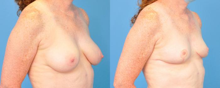 Before & After Breast Reduction Case 243 View #3 View in North Shore, IL