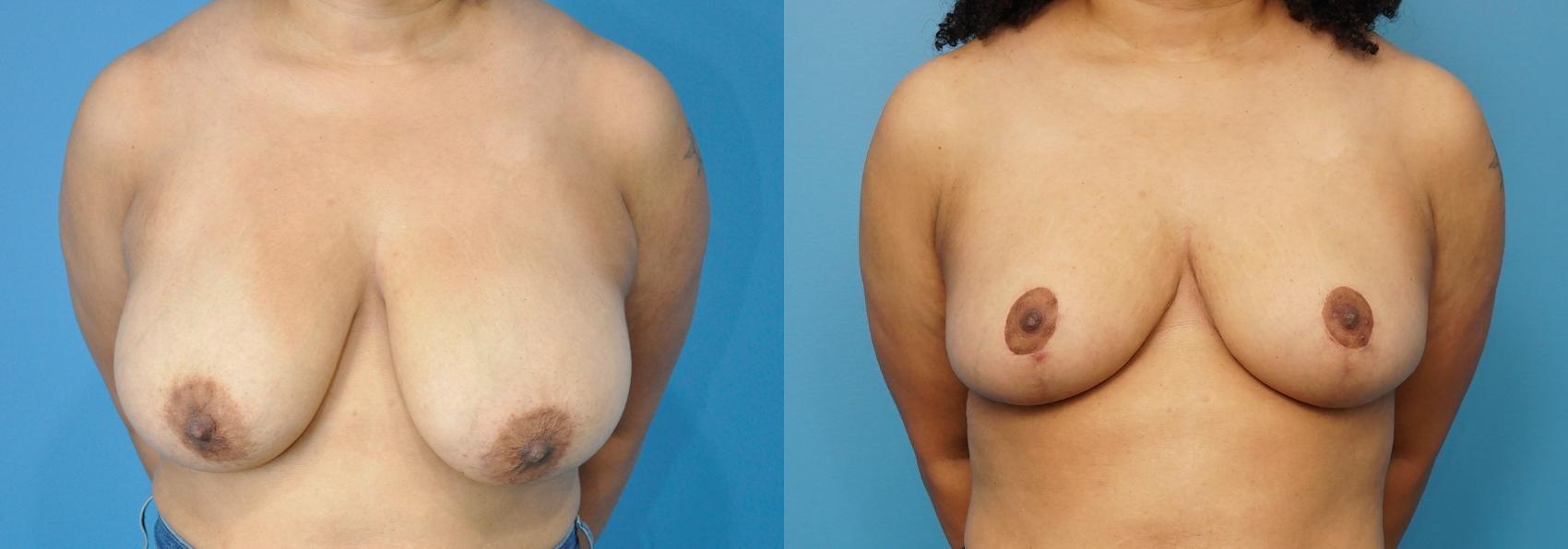 Before & After Breast Reduction Case 244 View #1 View in North Shore, IL