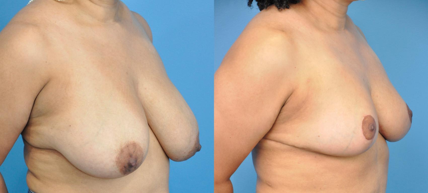 Before & After Breast Reduction Case 244 View #2 View in Northbrook, IL