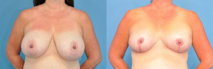 Before & After Breast Reduction Case 245 View #1 View in Northbrook, IL