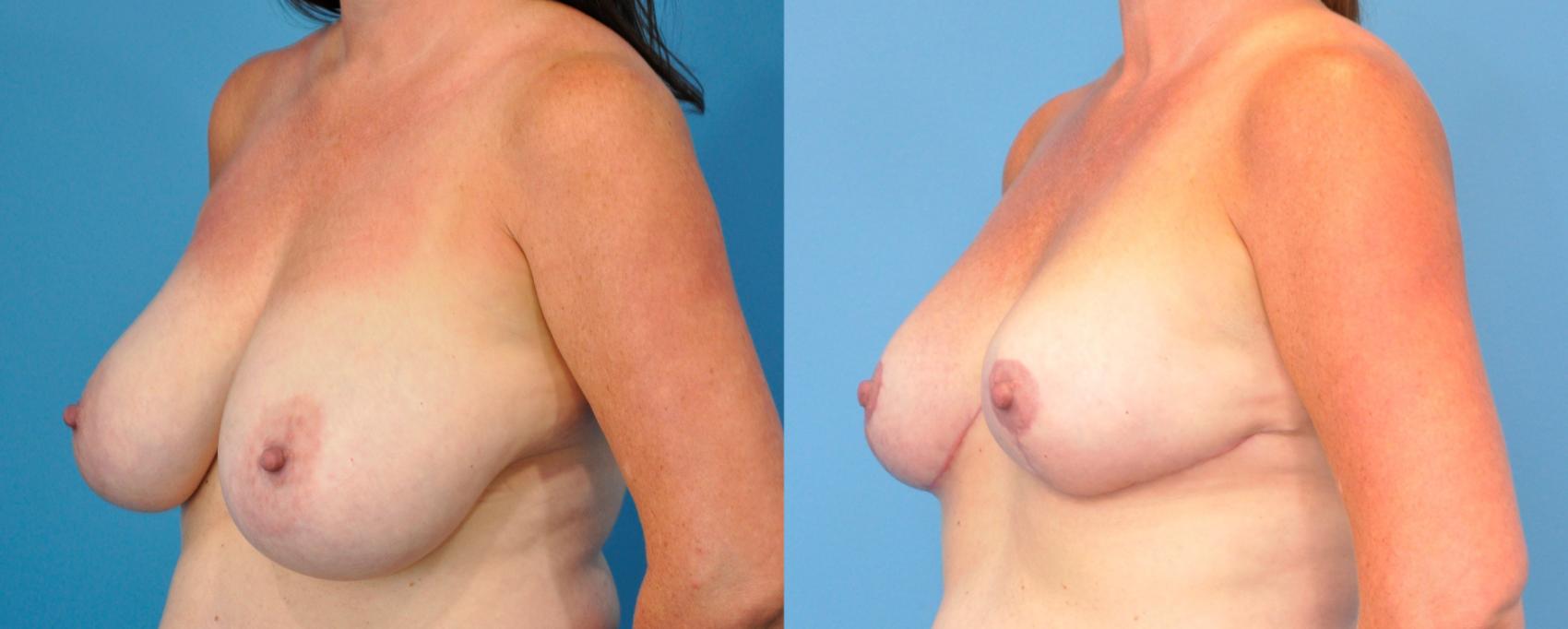 Before & After Breast Reduction Case 245 View #2 View in Northbrook, IL