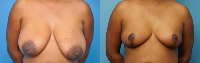 Before & After Breast Reduction Case 250 View #1 View in North Shore, IL