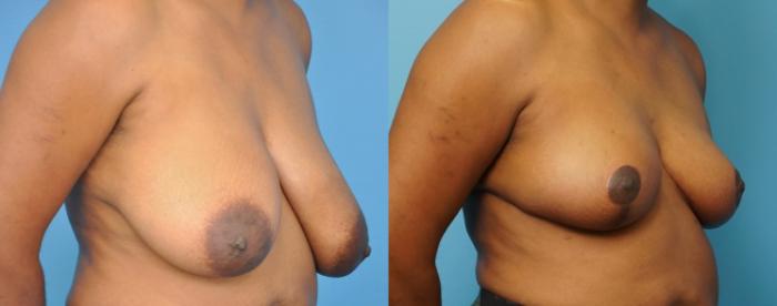 Before & After Breast Reduction Case 250 View #2 View in North Shore, IL