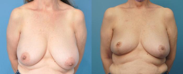 Before & After Breast Reduction Case 256 View #1 View in Northbrook, IL