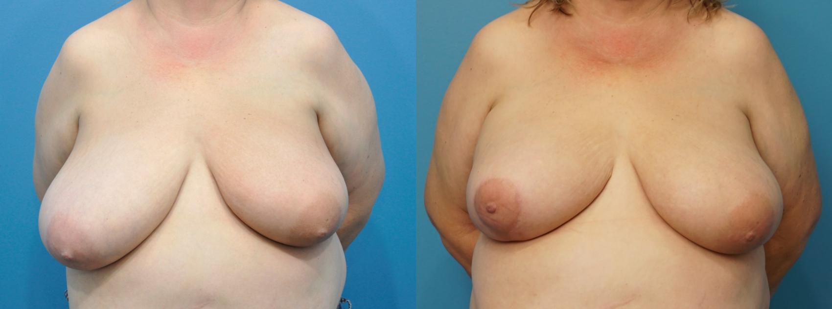 Before & After Breast Reduction Case 259 View #1 View in Northbrook, IL