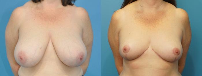 Before & After Breast Reduction Case 260 View #1 View in North Shore, IL