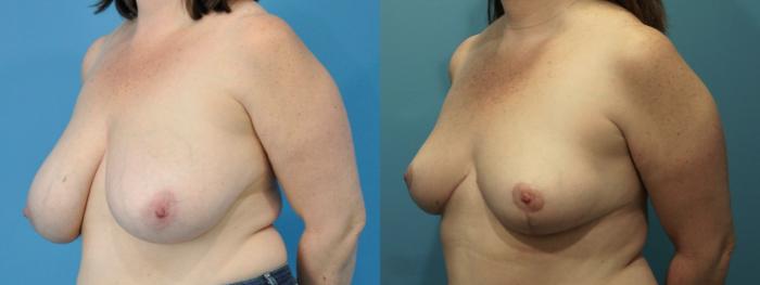 Before & After Breast Reduction Case 260 View #2 View in North Shore, IL