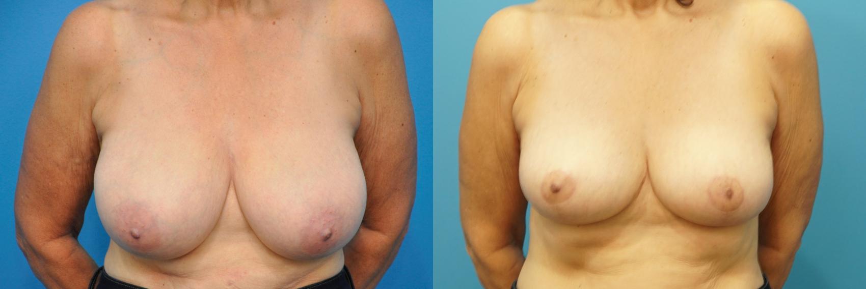 Before & After Breast Reduction Case 261 View #1 View in North Shore, IL