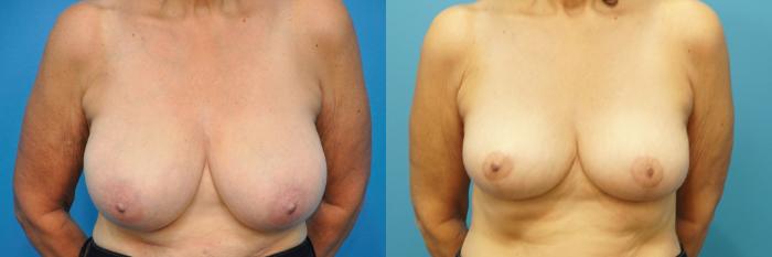 Before & After Breast Reduction Case 261 View #1 View in Northbrook, IL