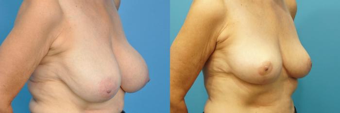 Before & After Breast Reduction Case 261 View #2 View in North Shore, IL