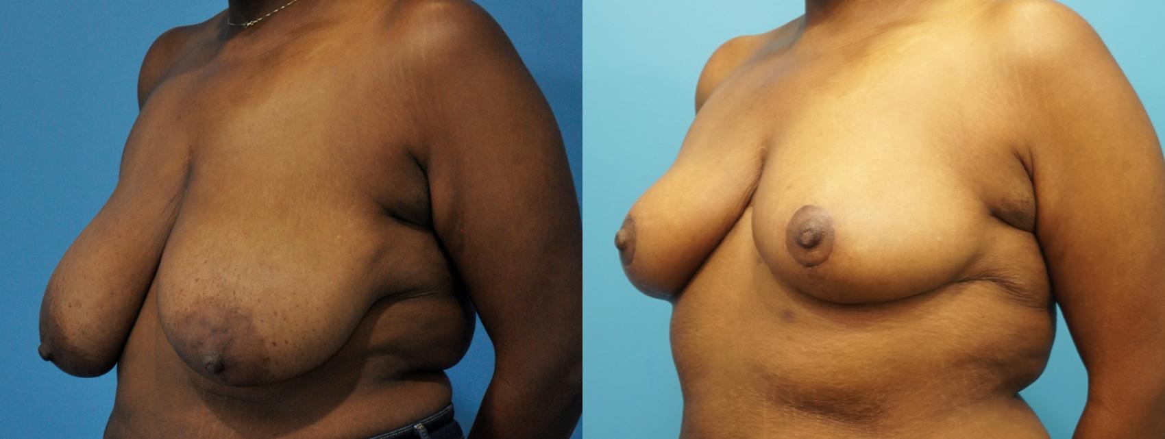 Before & After Breast Reduction Case 266 View #1 View in Northbrook, IL