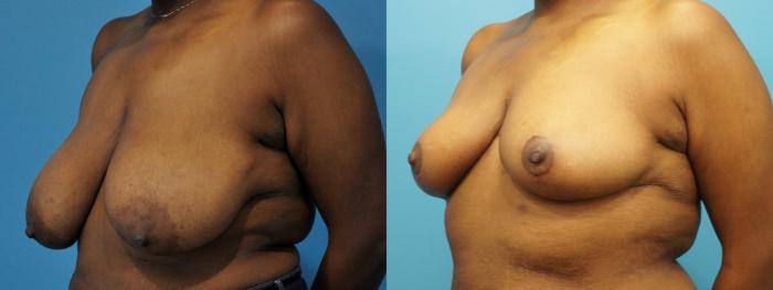 Before & After Breast Reduction Case 266 View #1 View in North Shore, IL