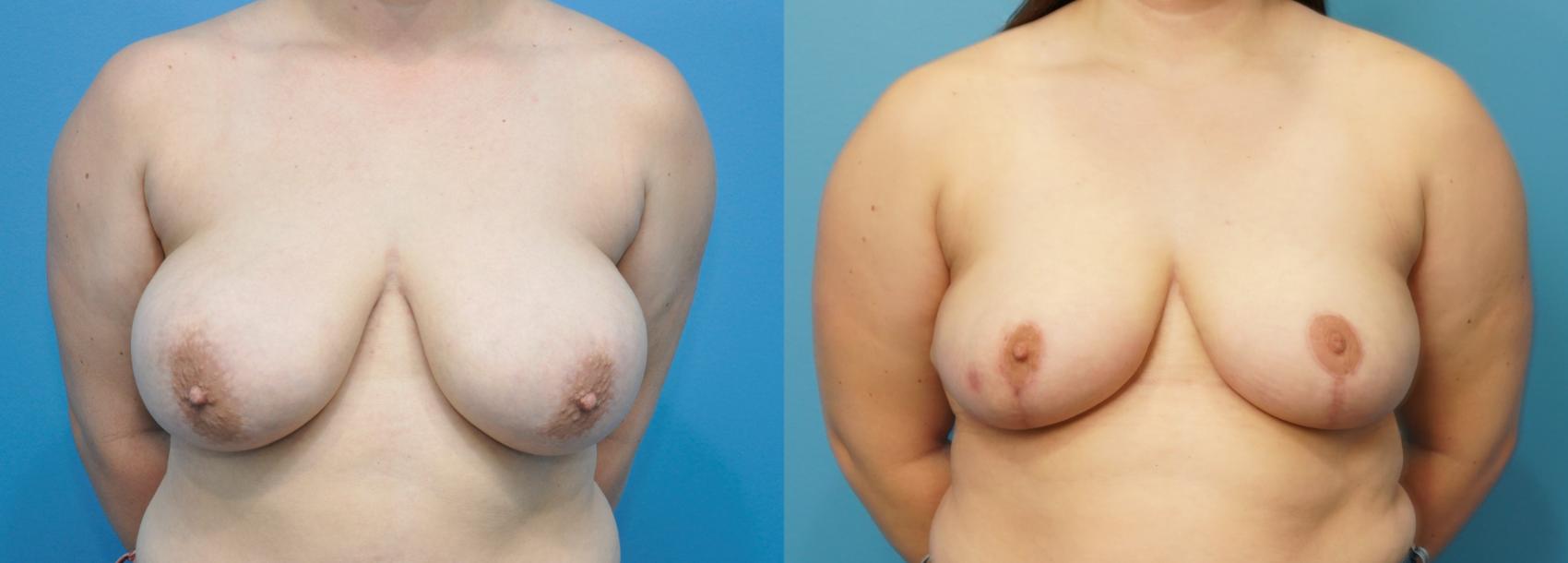 Before & After Breast Reduction Case 267 View #1 View in North Shore, IL