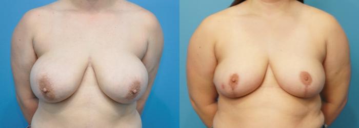 Before & After Breast Reduction Case 267 View #1 View in Northbrook, IL