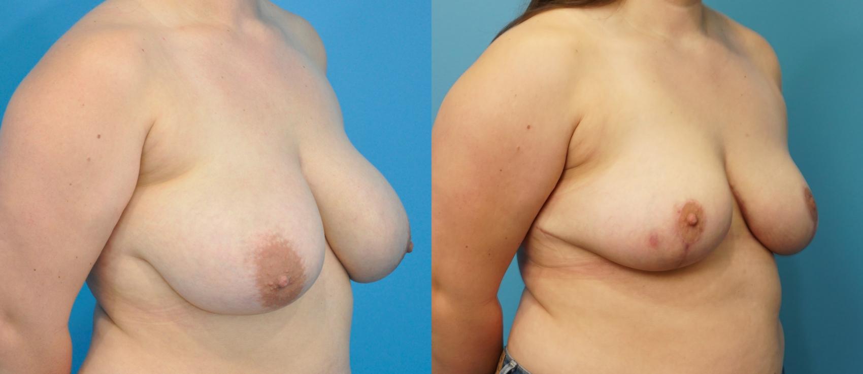 Before & After Breast Reduction Case 267 View #2 View in Northbrook, IL