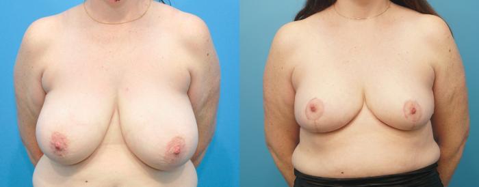 Before & After Breast Reduction Case 268 Front View in Northbrook, IL