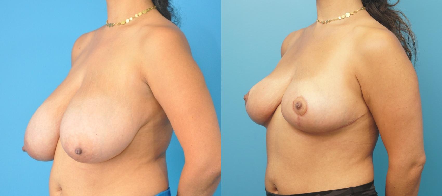 Before & After Breast Reduction Case 271 Left Oblique View in Northbrook, IL