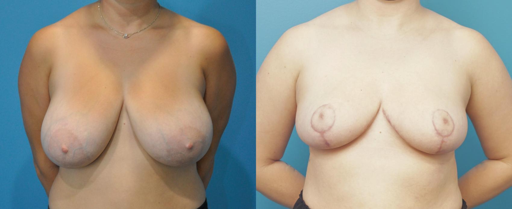 Before & After Breast Reduction Case 274 Front View in North Shore, IL