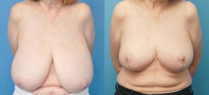 Before & After Breast Reduction Case 278 Front View in North Shore, IL