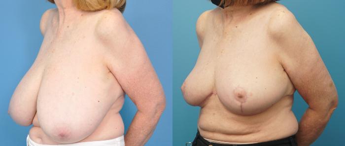 Before & After Breast Reduction Case 278 Left Oblique View in North Shore, IL