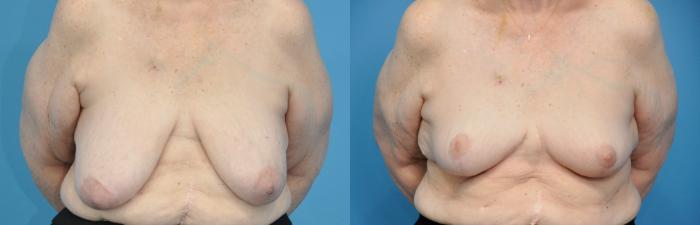 Before & After Breast Reduction Case 290 Front View in Northbrook, IL