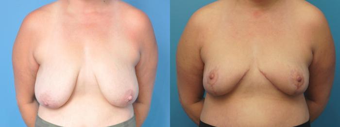 Before & After Breast Reduction Case 293 Front View in North Shore, IL