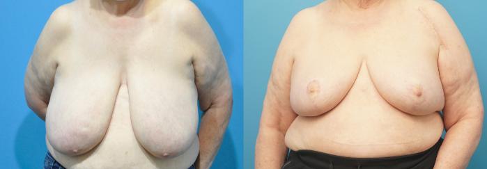 Before & After Breast Reduction Case 296 Front View in North Shore, IL