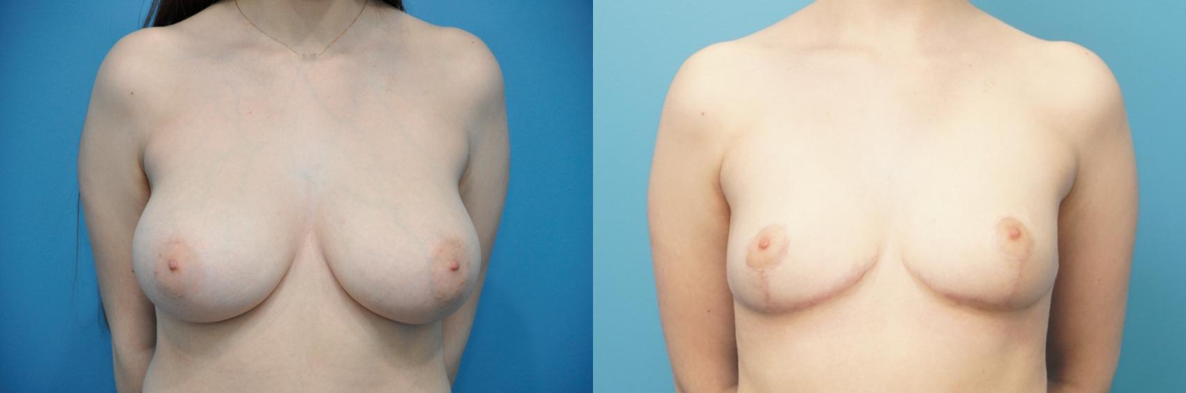 Before & After Breast Reduction Case 297 Front View in Northbrook, IL
