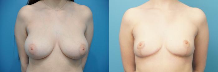 Before & After Breast Lift (Mastopexy) Case 297 Front View in Northbrook, IL