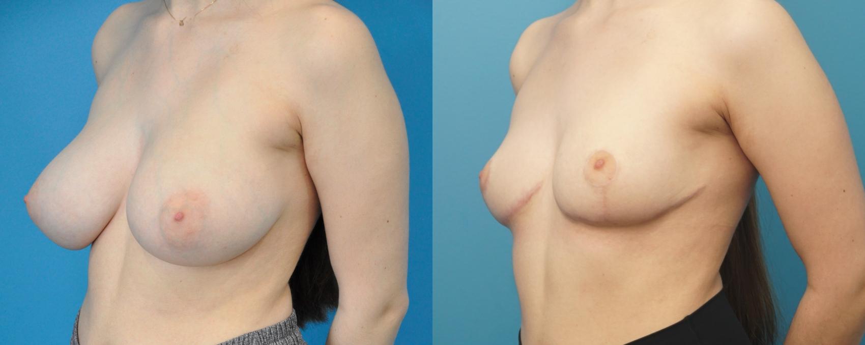 Before & After Breast Reduction Case 297 Left Oblique View in Northbrook, IL