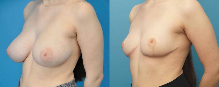 Before & After Breast Lift (Mastopexy) Case 297 Left Oblique View in North Shore, IL