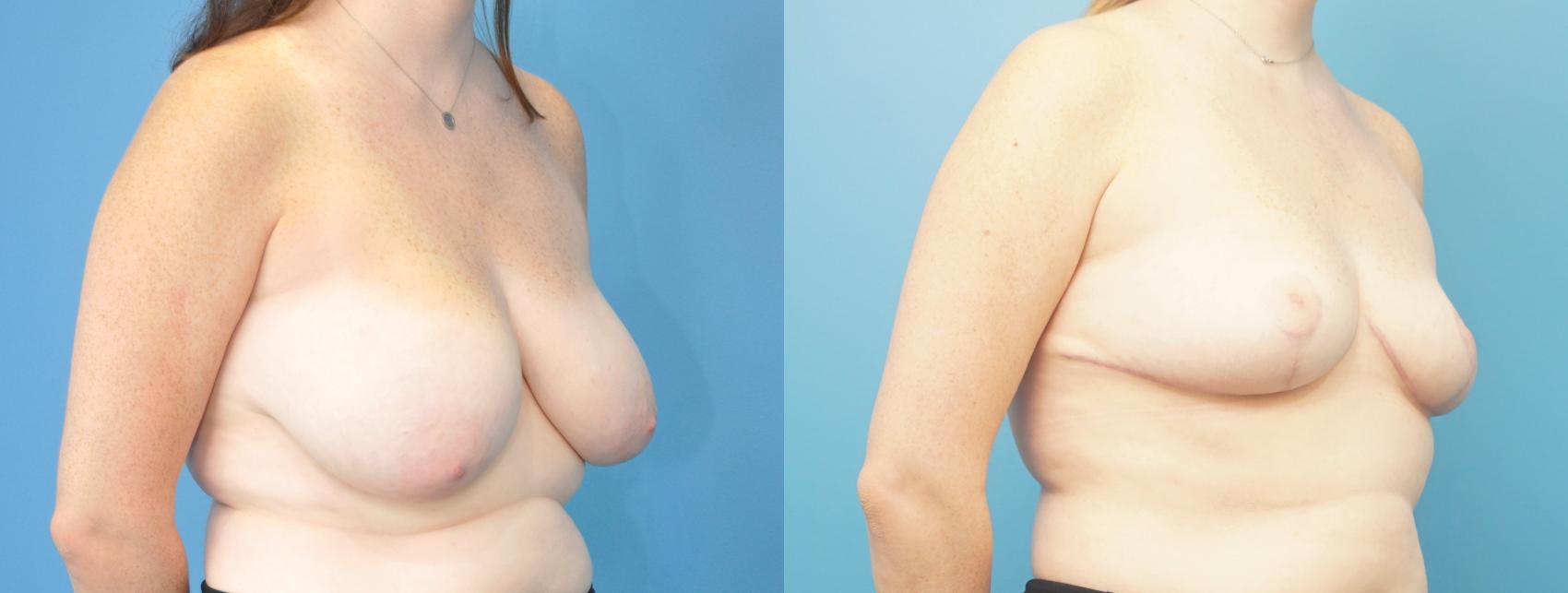 Before & After Breast Reduction Case 298 Right Oblique View in Northbrook, IL