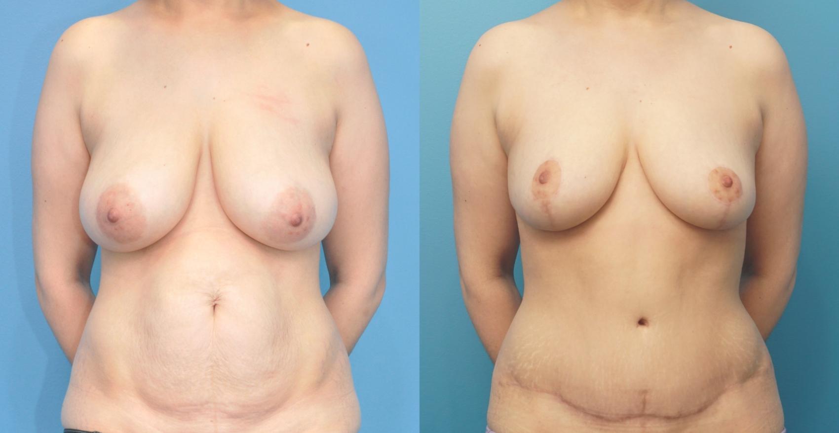 Before & After Abdominoplasty/Tummy Tuck Case 299 Front View in North Shore, IL