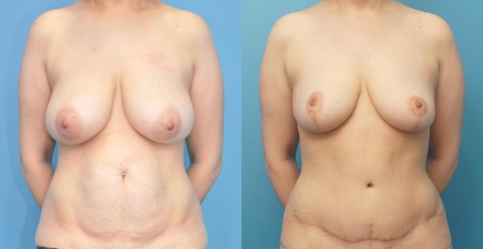 Before & After Breast Reduction Case 299 Front View in Northbrook, IL
