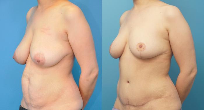 Before & After Breast Reduction Case 299 Left Oblique View in Northbrook, IL