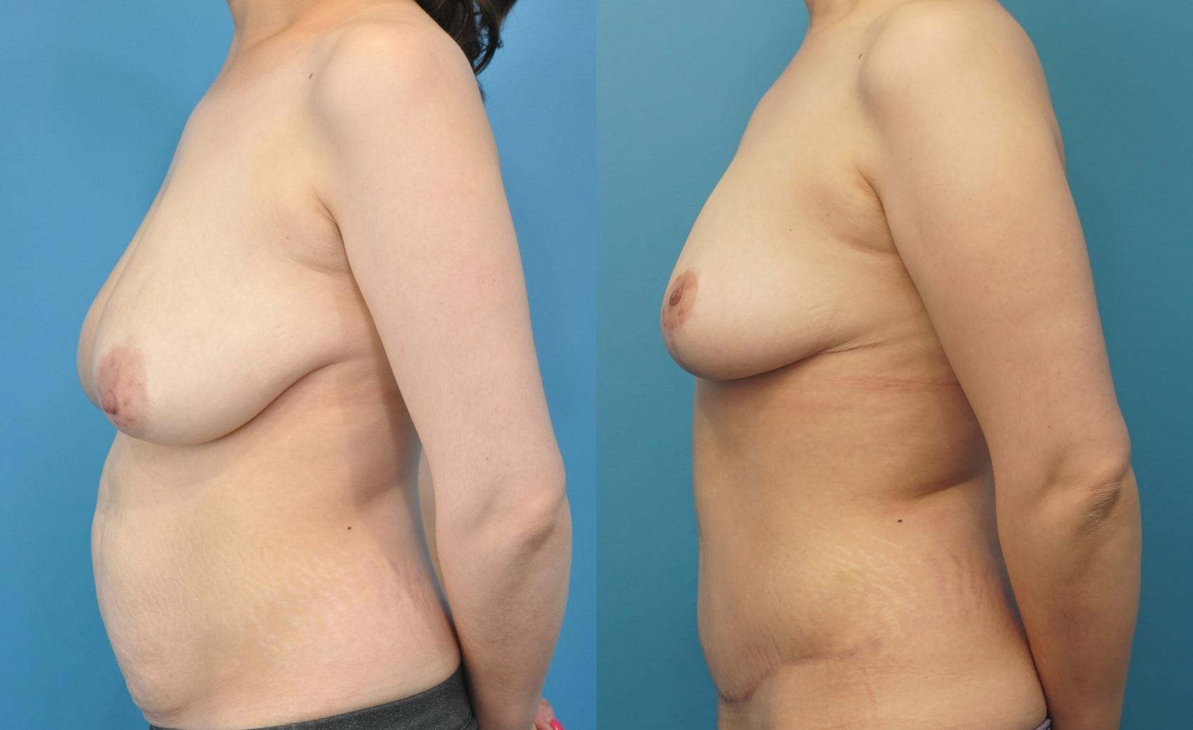 Before & After Breast Reduction Case 299 Left Side View in Northbrook, IL