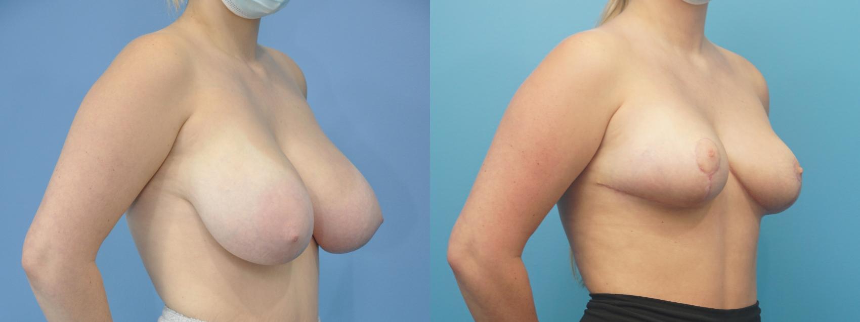 Before & After Breast Reduction Case 306 View #1 View in Northbrook, IL