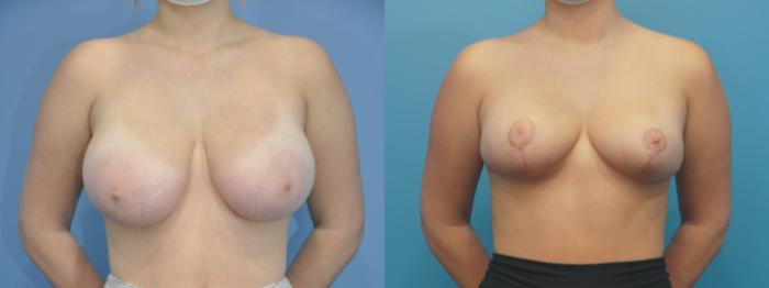 Before & After Breast Reduction Case 306 View #2 View in North Shore, IL