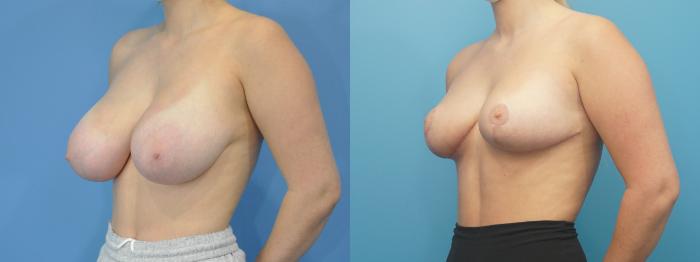 Before & After Breast Reduction Case 306 View #3 View in North Shore, IL
