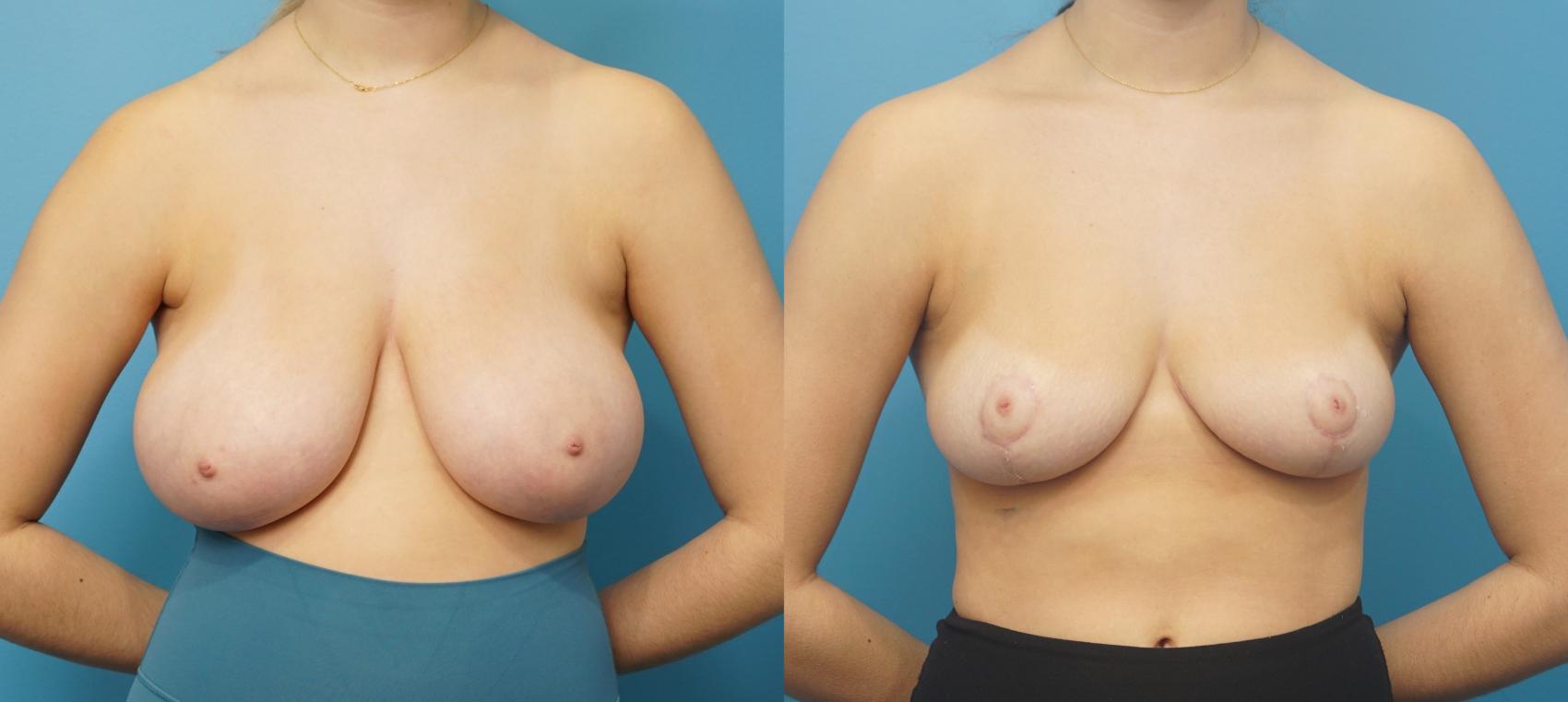 Before & After Breast Reduction Case 307 View #1 View in Northbrook, IL