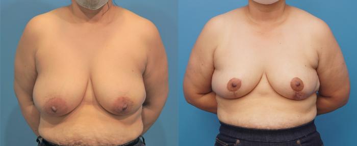Before & After Breast Reduction Case 326 Front View in Northbrook, IL