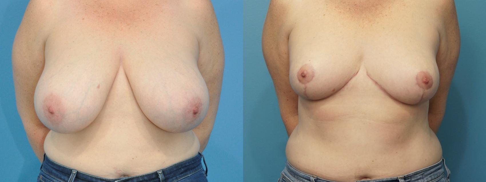 Before & After Breast Reduction Case 332 Front View in North Shore, IL