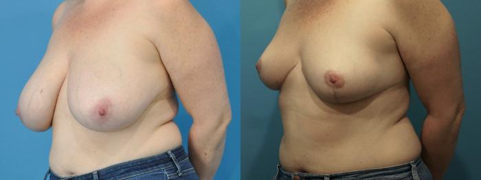 Before & After Breast Lift (Mastopexy) Case 332 Left Oblique View in North Shore, IL