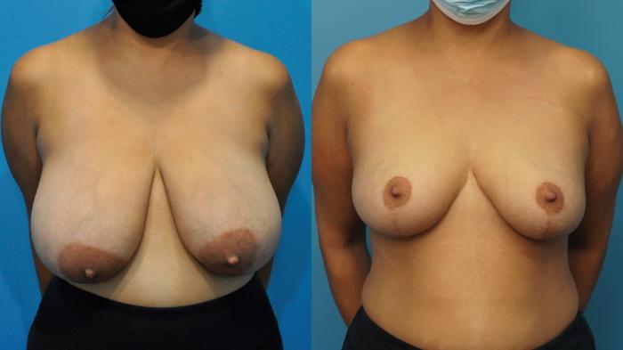 Before & After Breast Reduction Case 360 Front View in Northbrook, IL
