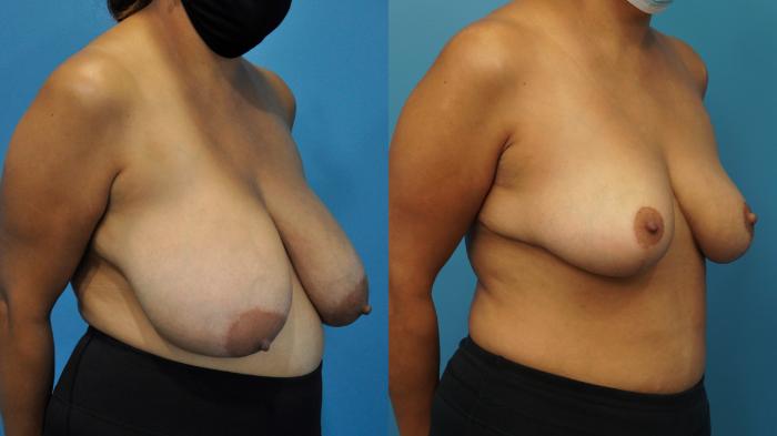 Before & After Breast Reduction Case 360 Right Oblique View in Northbrook, IL